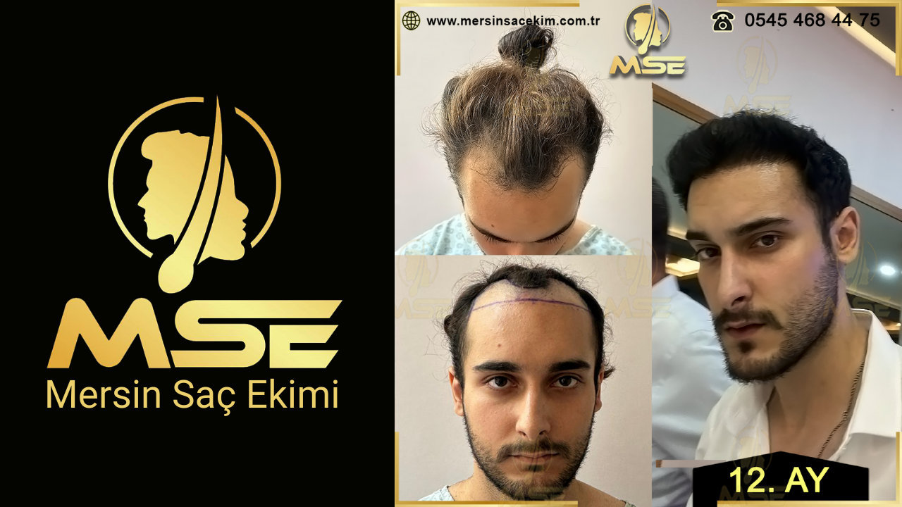 Mersin Saç Ekimi